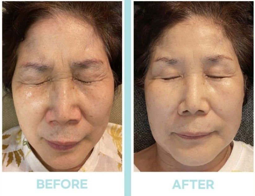 달리 마스크 사용 전후 — 눈가·볼 탄력 개선
