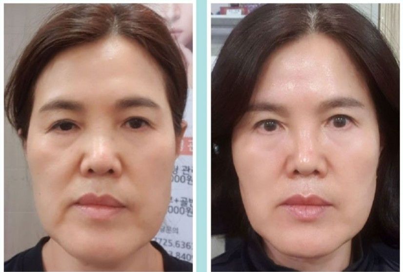 달리 마스크 사용 전후 — 윤곽·리프팅 개선